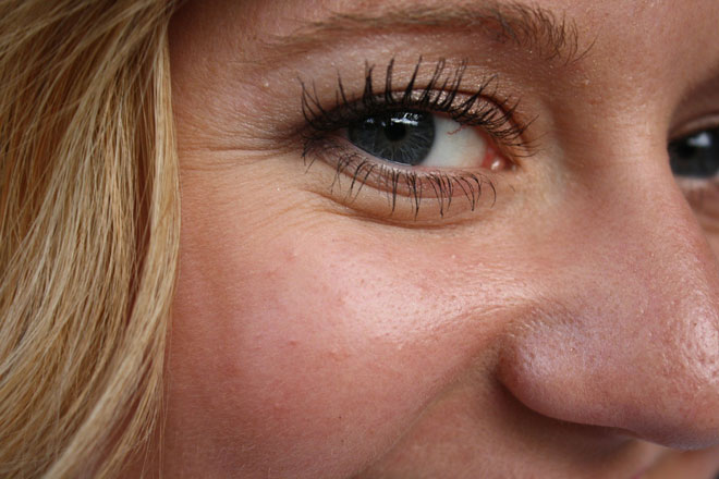 efeitos colaterais do botox no rosto